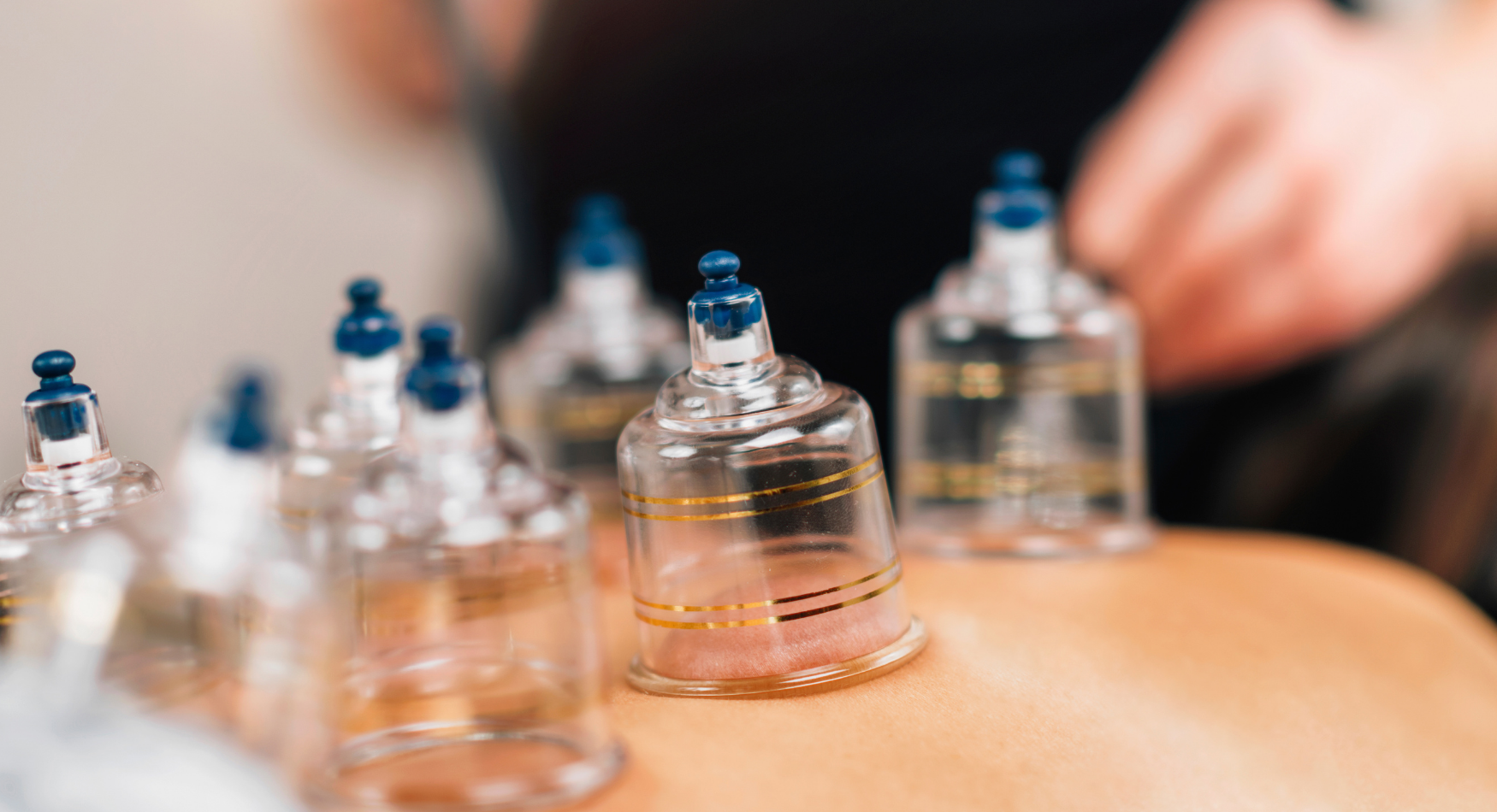 What Is Cupping Therapy And How Does It Work