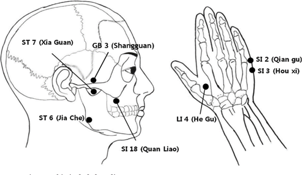 How Acupuncture Works for TMJ Dysfunction